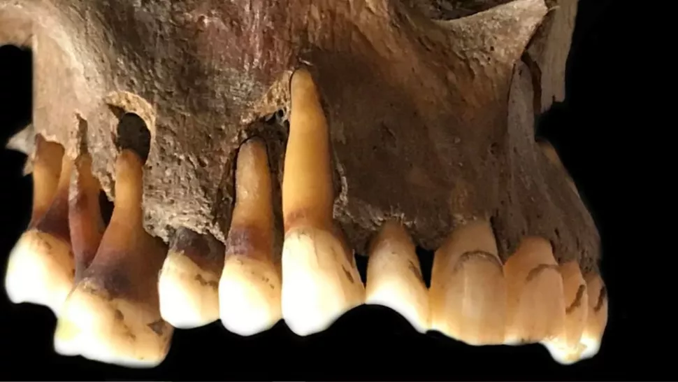研究人员在古代人类牙齿中发现了疱疹病毒 DNA 的痕迹。 （图片来源：Barbara Veselka 博士）