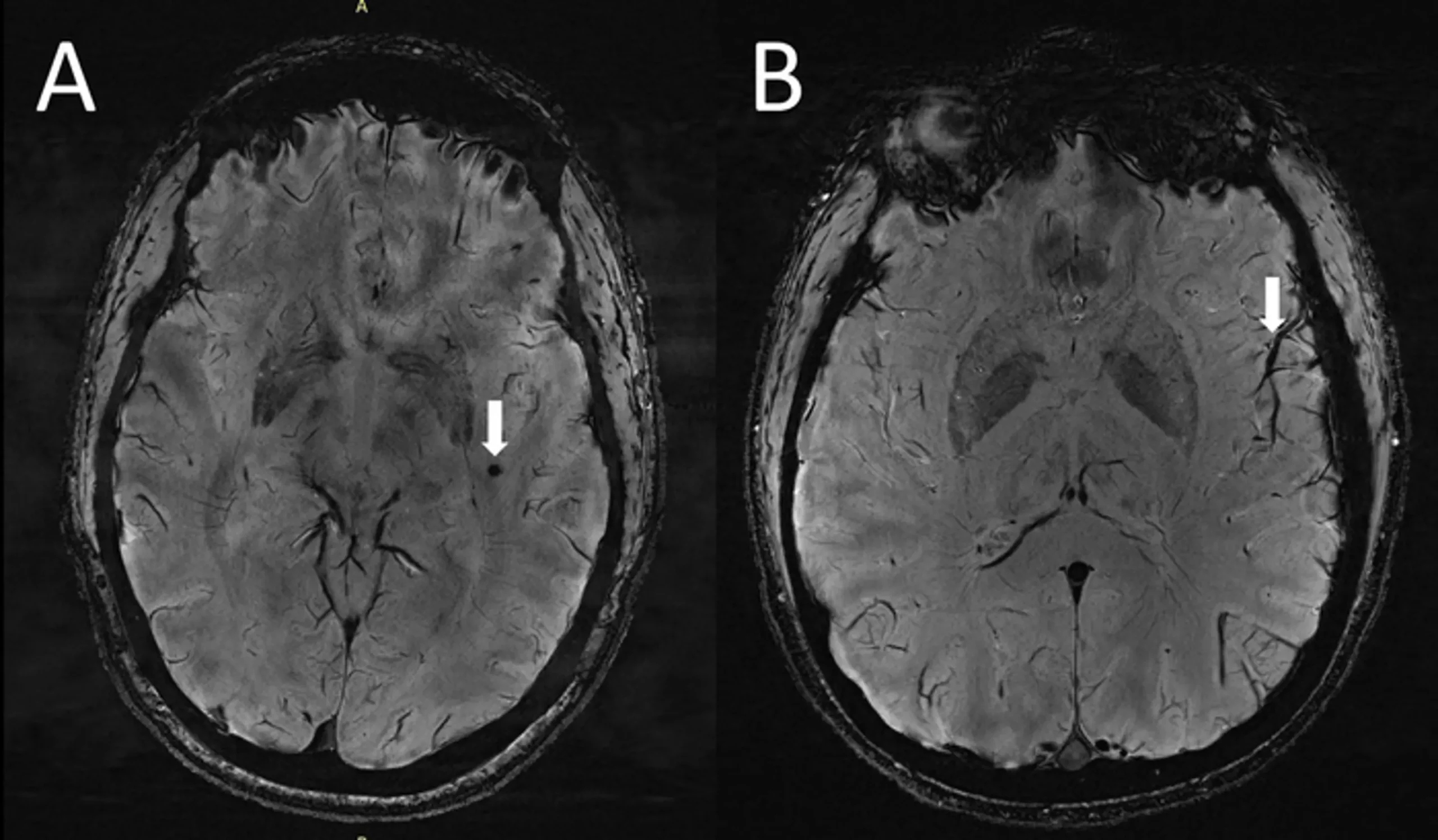 脑部成像显示了偏头痛患者大脑中的明显特征，这里描述的是脑部微出血（左）和血管周围空间扩大（右）