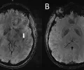 核磁共振成像显示偏头痛患者大脑中从未见过的空间